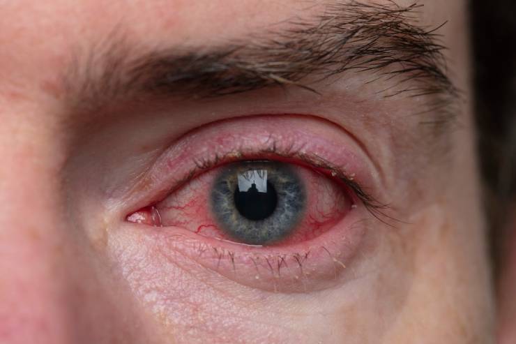 Conjunctivitis (Pink Eye)